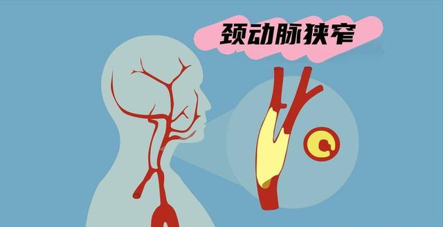 男子血管狭窄75%，2年后恢复通畅，他的7个习惯值得借鉴